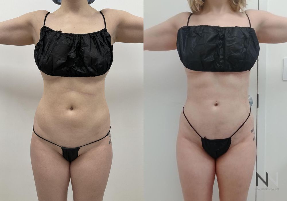 Liposuction - Case 2071