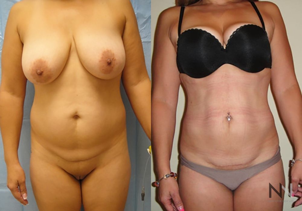 Liposuction - Case 2060
