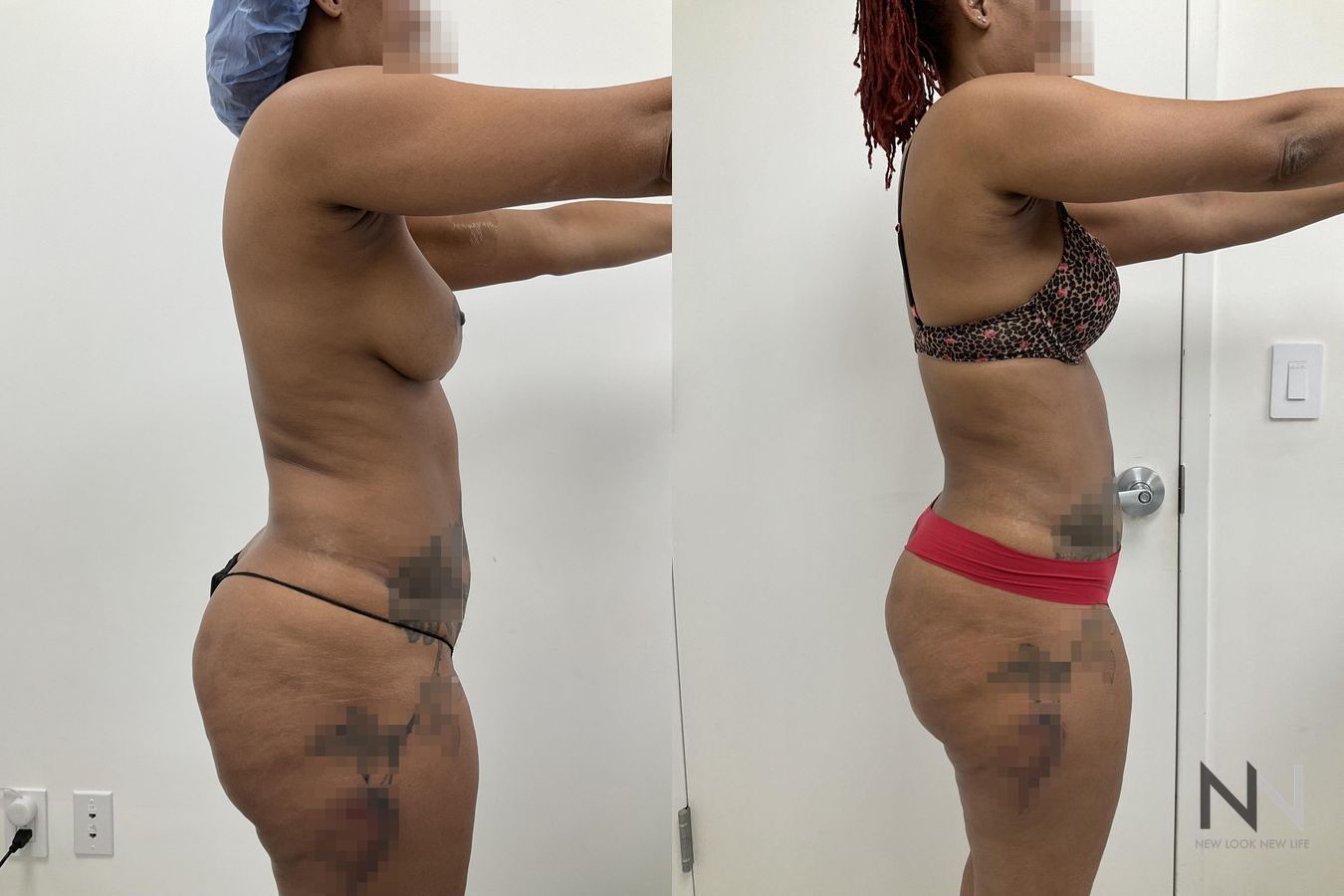 Before and after VASER liposuction with J-Plasma six months results - Angle 4