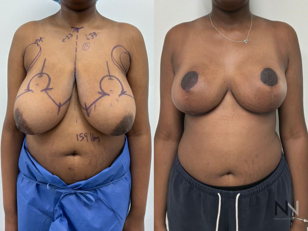 Breast reduction before and after by Dr. Claudia Kim at New Look New Life in NYC, showing improved breast size, shape, and overall body proportions.