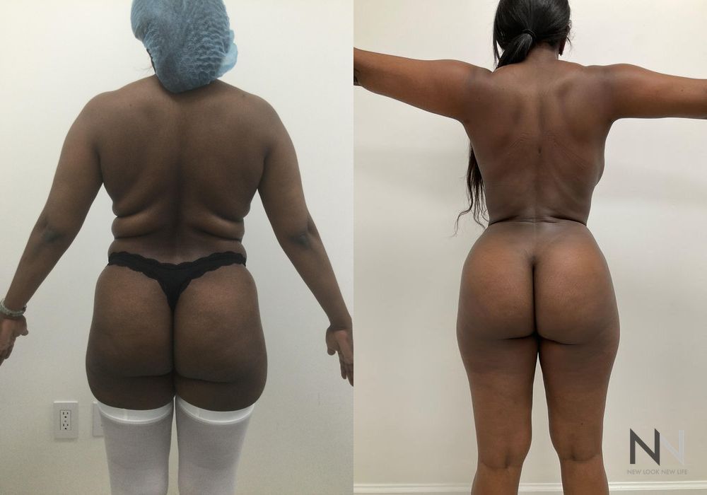 Liposuction - Thumbnail 2