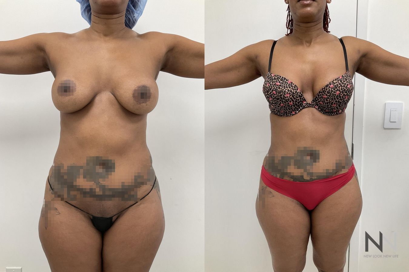 Before and after VASER liposuction with J-Plasma six months results - Angle 3