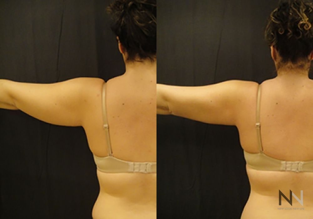 Liposuction - Case 2073