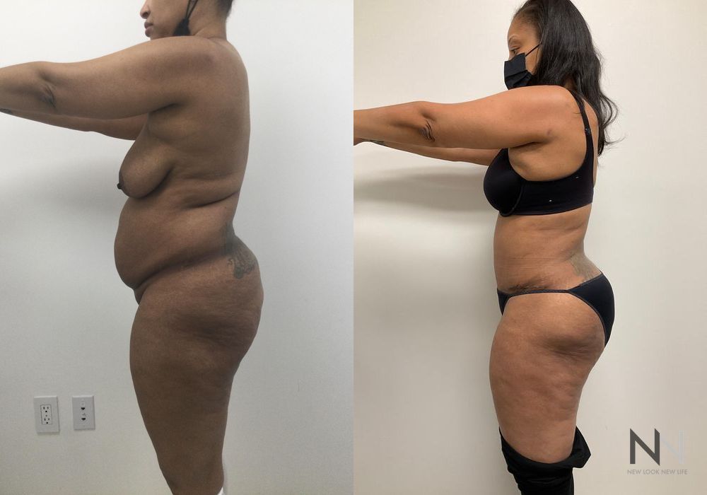 Liposuction - Thumbnail 3