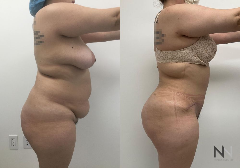 Liposuction - Case 2061