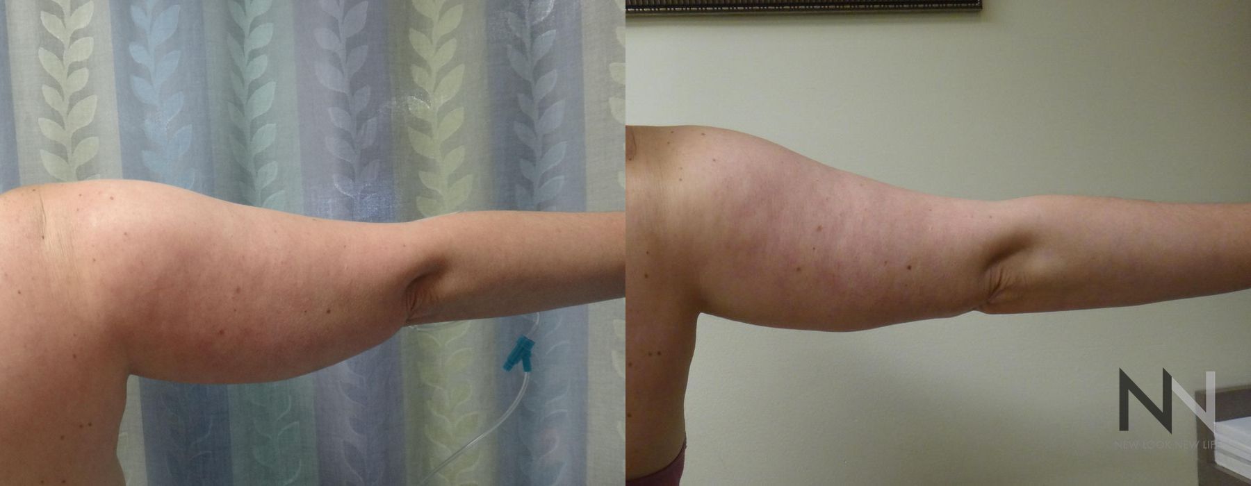 Liposuction - Thumbnail 4