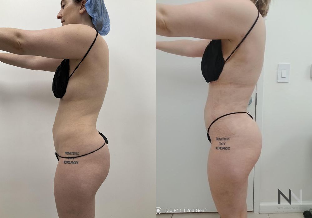 Liposuction - Thumbnail 3