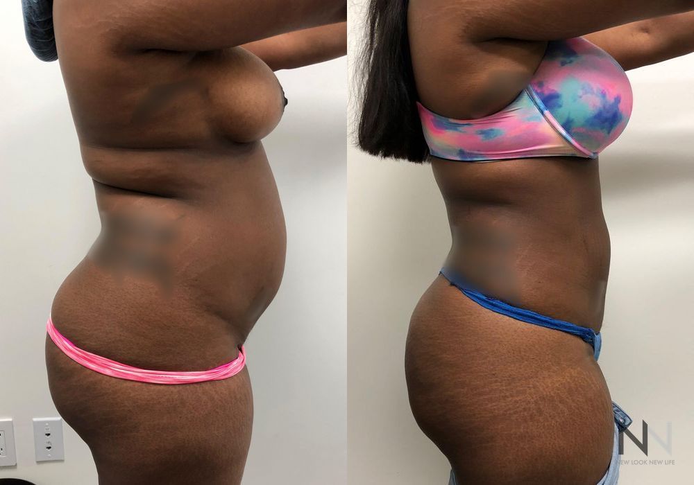 Liposuction - Thumbnail 3