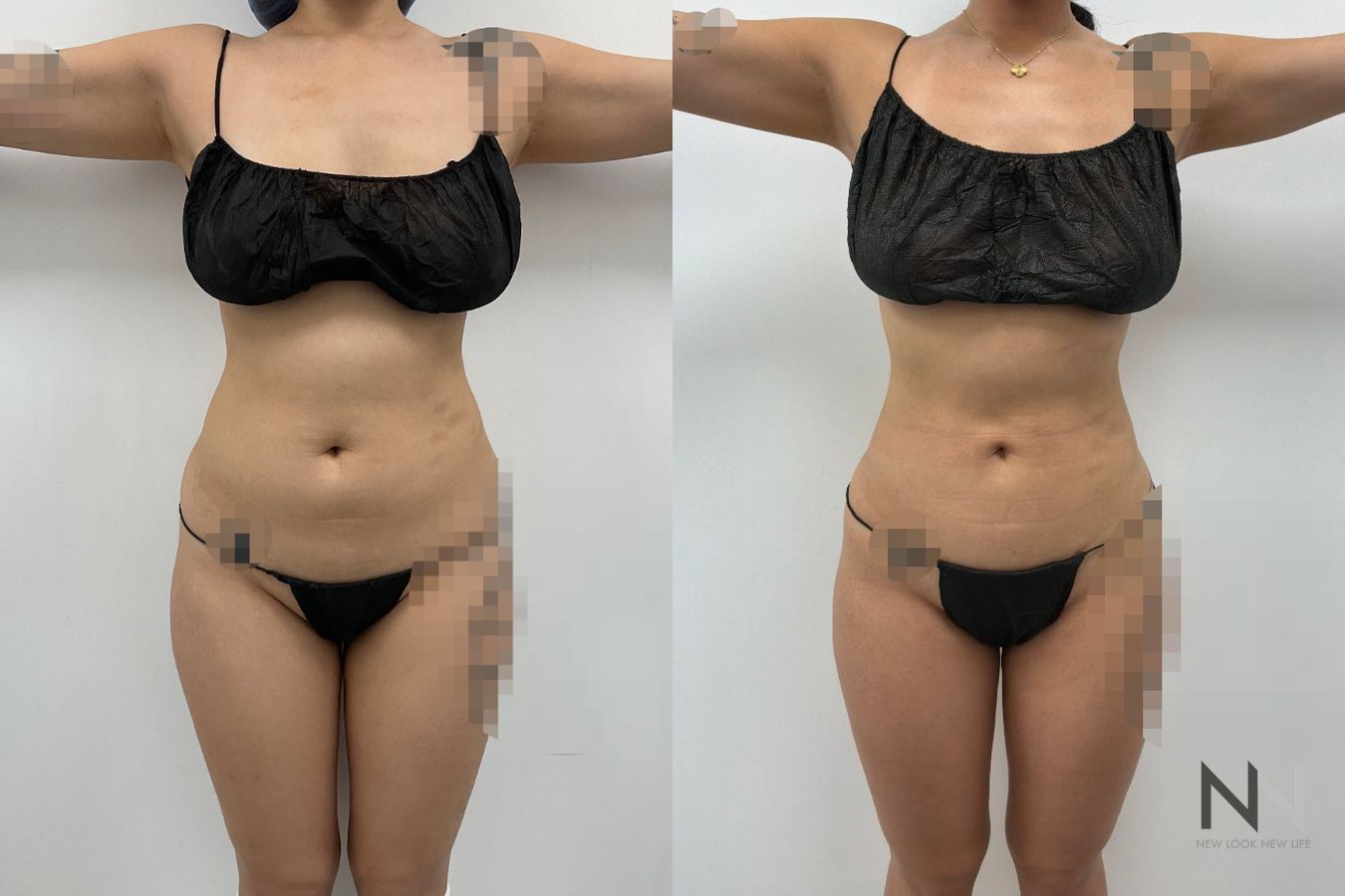 Liposuction before and after showing improved abdominal, flank, back and arm contours by Dr. Claudia Kim in NYC.