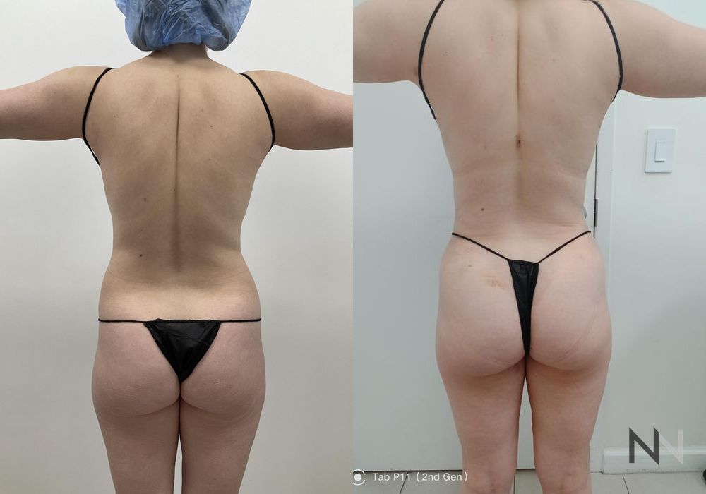 Liposuction - Thumbnail 4