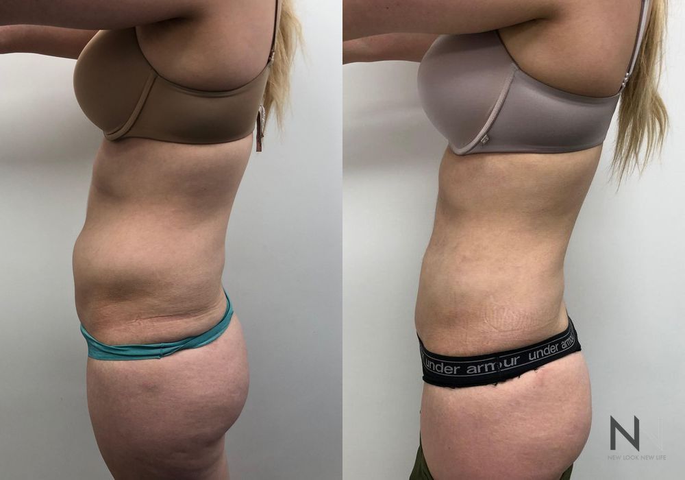 Liposuction - Thumbnail 3