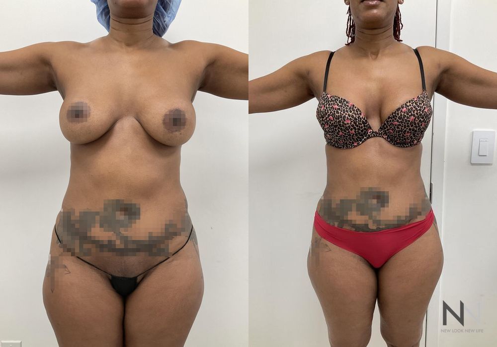 Liposuction - Case 1891