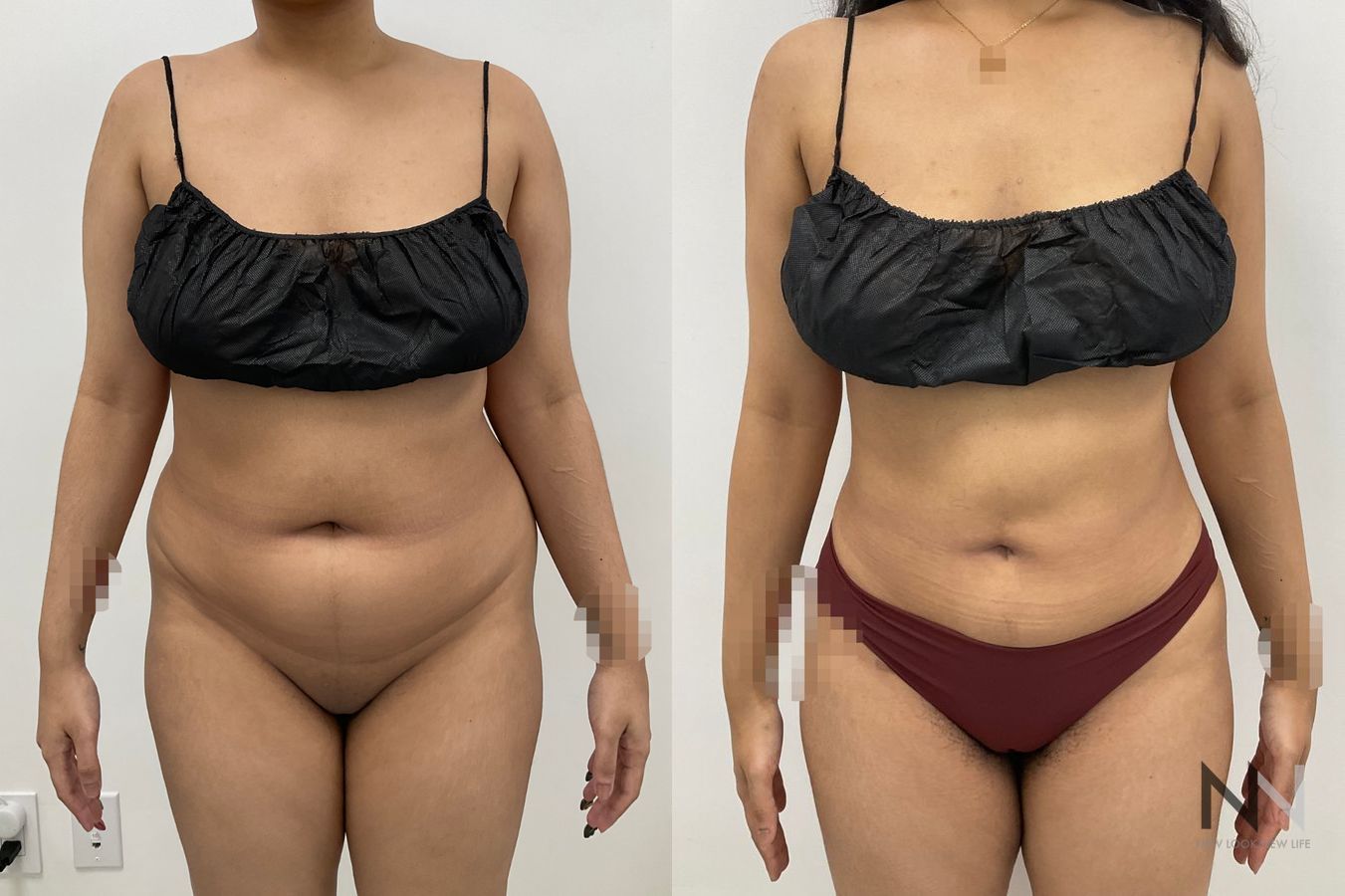 Fat grafting before and after showing enhanced lateral hip contours following fat transfer by Dr. Claudia Kim in NYC. - Angle 3