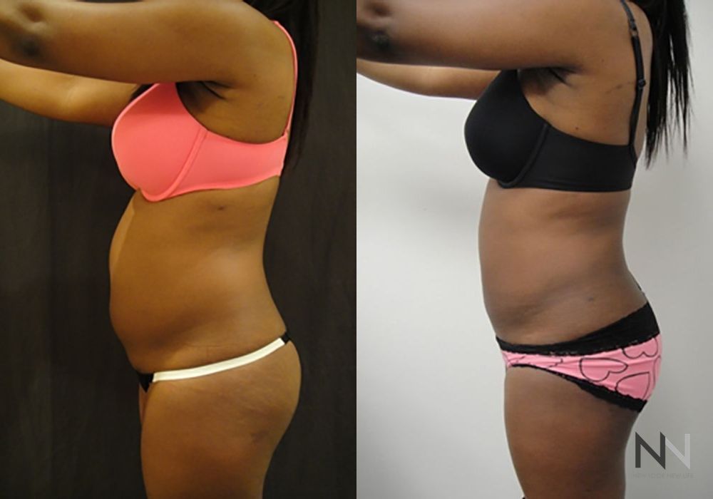 Liposuction - Thumbnail 3