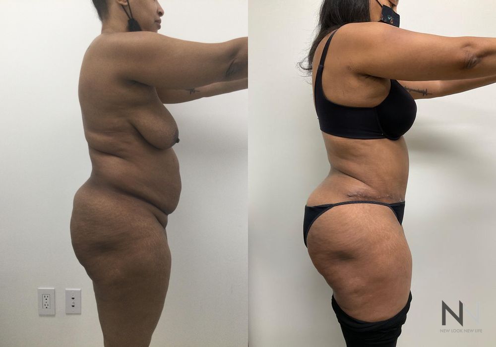 Liposuction - Thumbnail 2