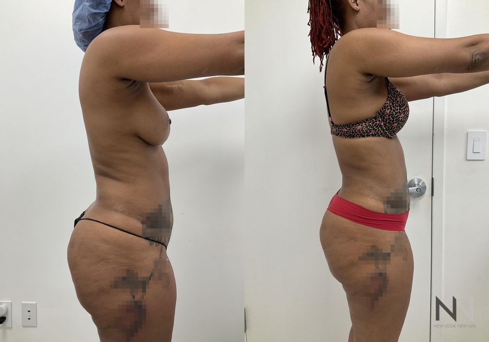 Liposuction - Thumbnail 4