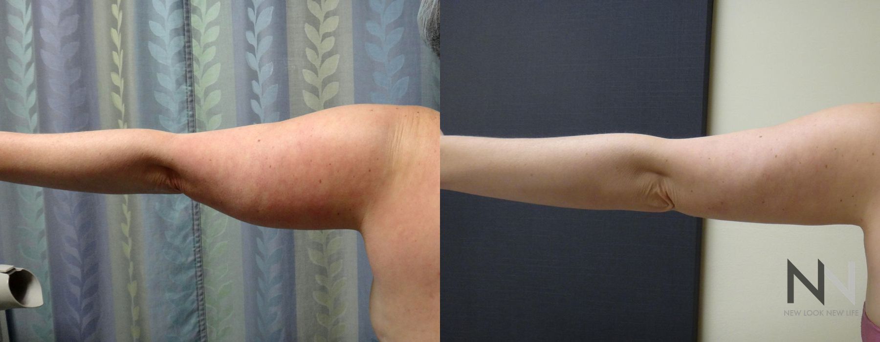 Liposuction - Case 2072