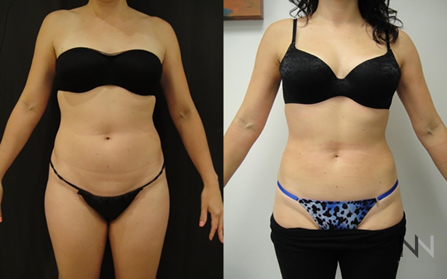 Before and after liposuction six months results