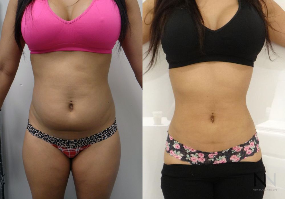 Liposuction - Case 2057