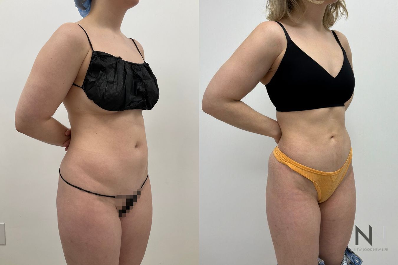 Liposuction 360 before and after showing abdominal, flank, back, and waist contouring by Dr. Claudia Kim in Manhattan, NYC - Angle 5