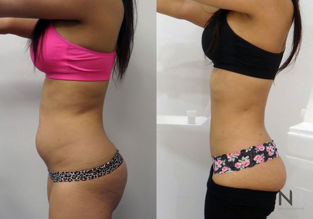 Liposuction - Thumbnail 3