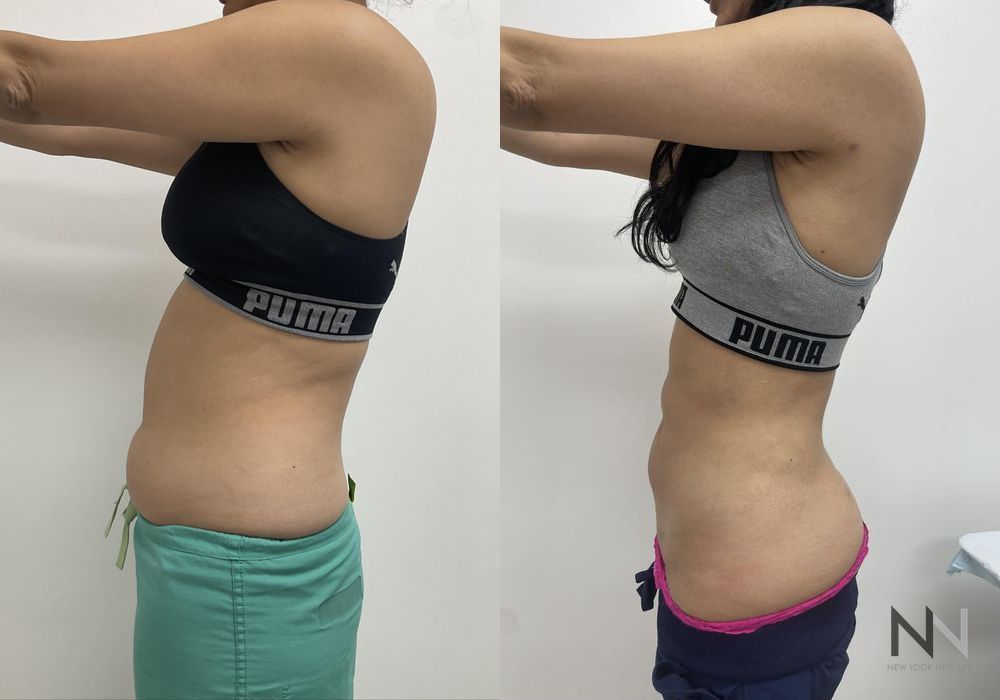 Liposuction - Thumbnail 3