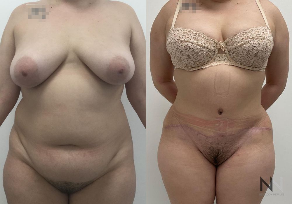 Liposuction - Thumbnail 2