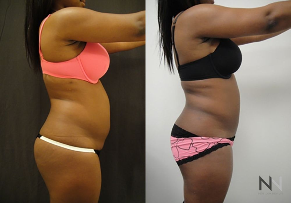 Liposuction - Thumbnail 2