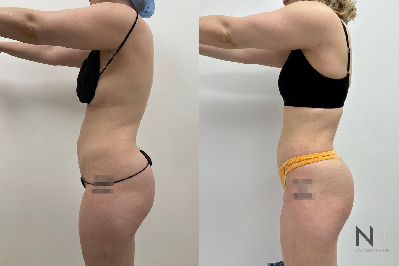 Liposuction 360 before and after showing abdominal, flank, back, and waist contouring by Dr. Claudia Kim in Manhattan, NYC - Angle 2
