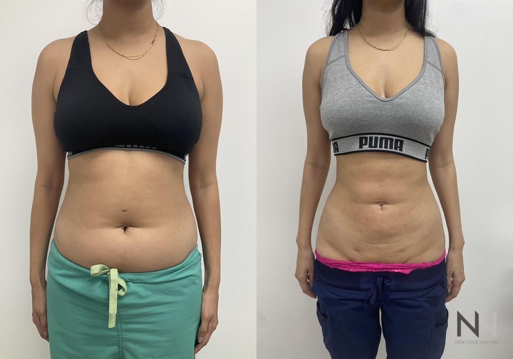 Liposuction - Case 1886