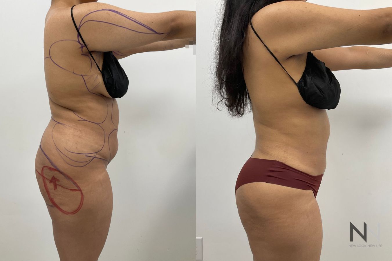 Fat grafting before and after showing enhanced lateral hip contours following fat transfer by Dr. Claudia Kim in NYC.