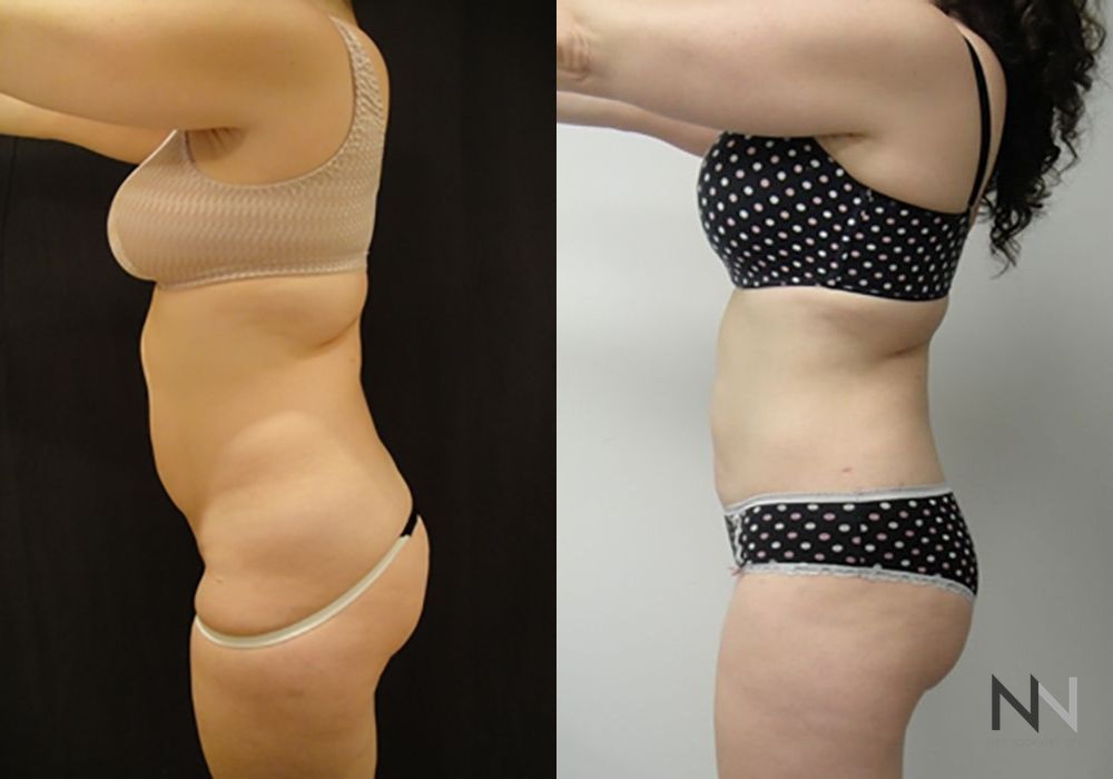 Liposuction - Thumbnail 2