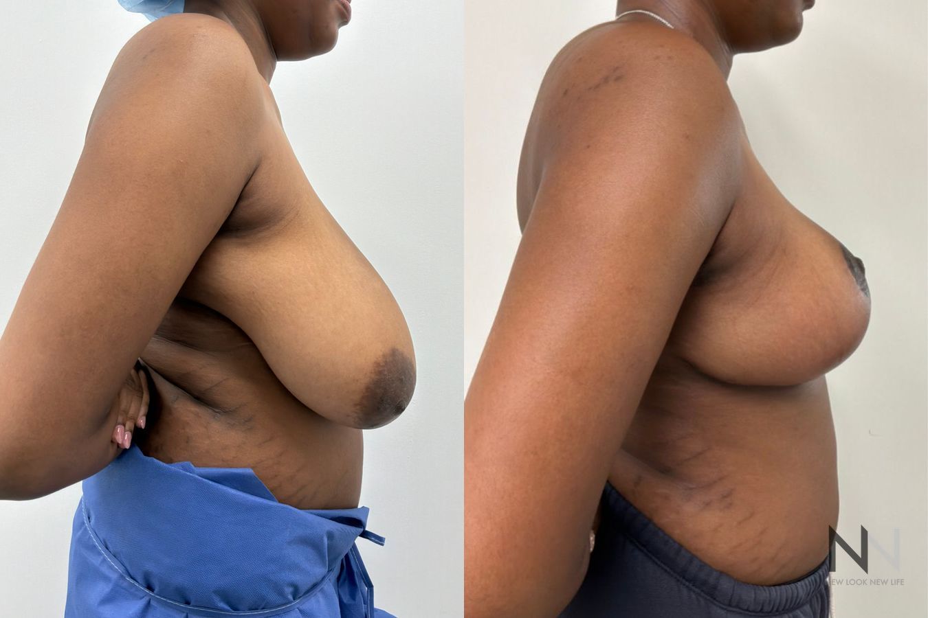 Breast reduction before and after by Dr. Claudia Kim at New Look New Life in NYC, showing improved breast size, shape, and overall body proportions. - Angle 2