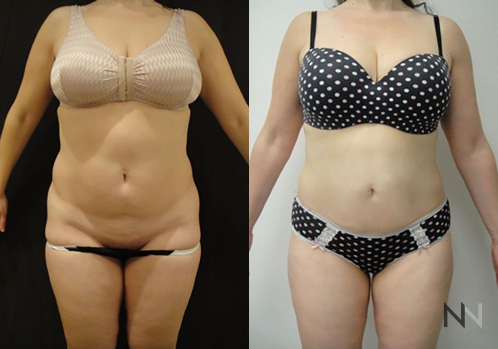 Liposuction - Case 2069