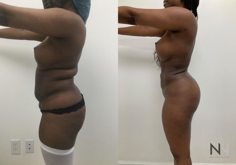 Liposuction - Thumbnail 3