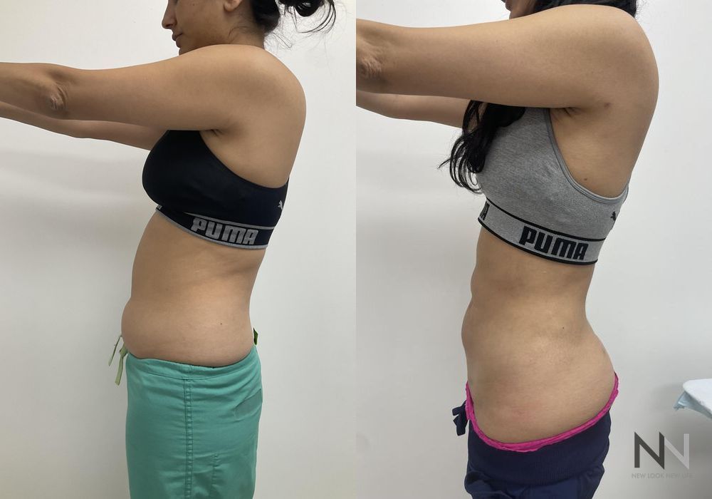 Liposuction - Thumbnail 3