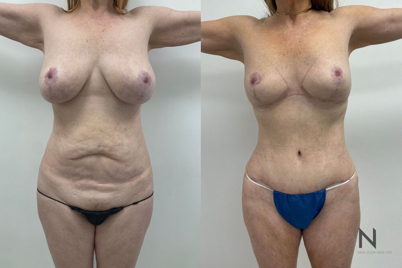 Flank liposuction before and after showing refined waistline and improved body contours by Dr. Claudia Kim in NYC - Angle 2