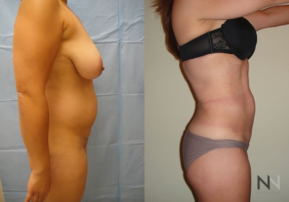 Liposuction - Thumbnail 3