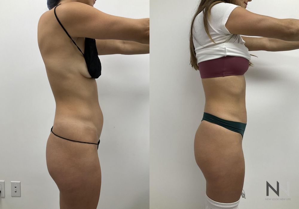 Liposuction - Thumbnail 2