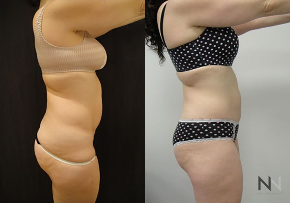 Liposuction - Thumbnail 3