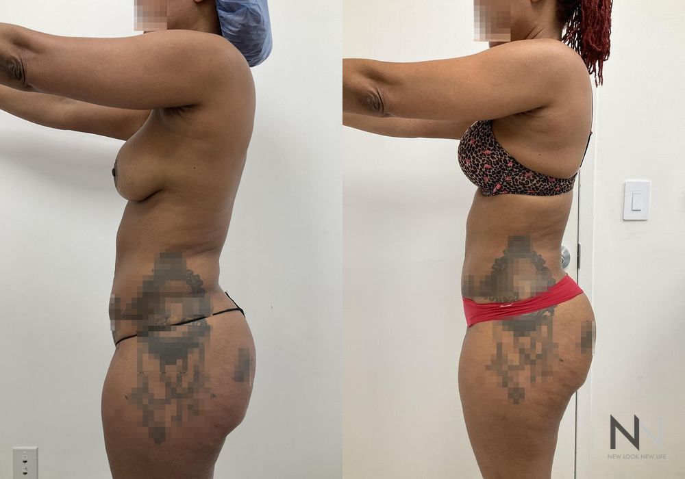 Liposuction - Case 2075