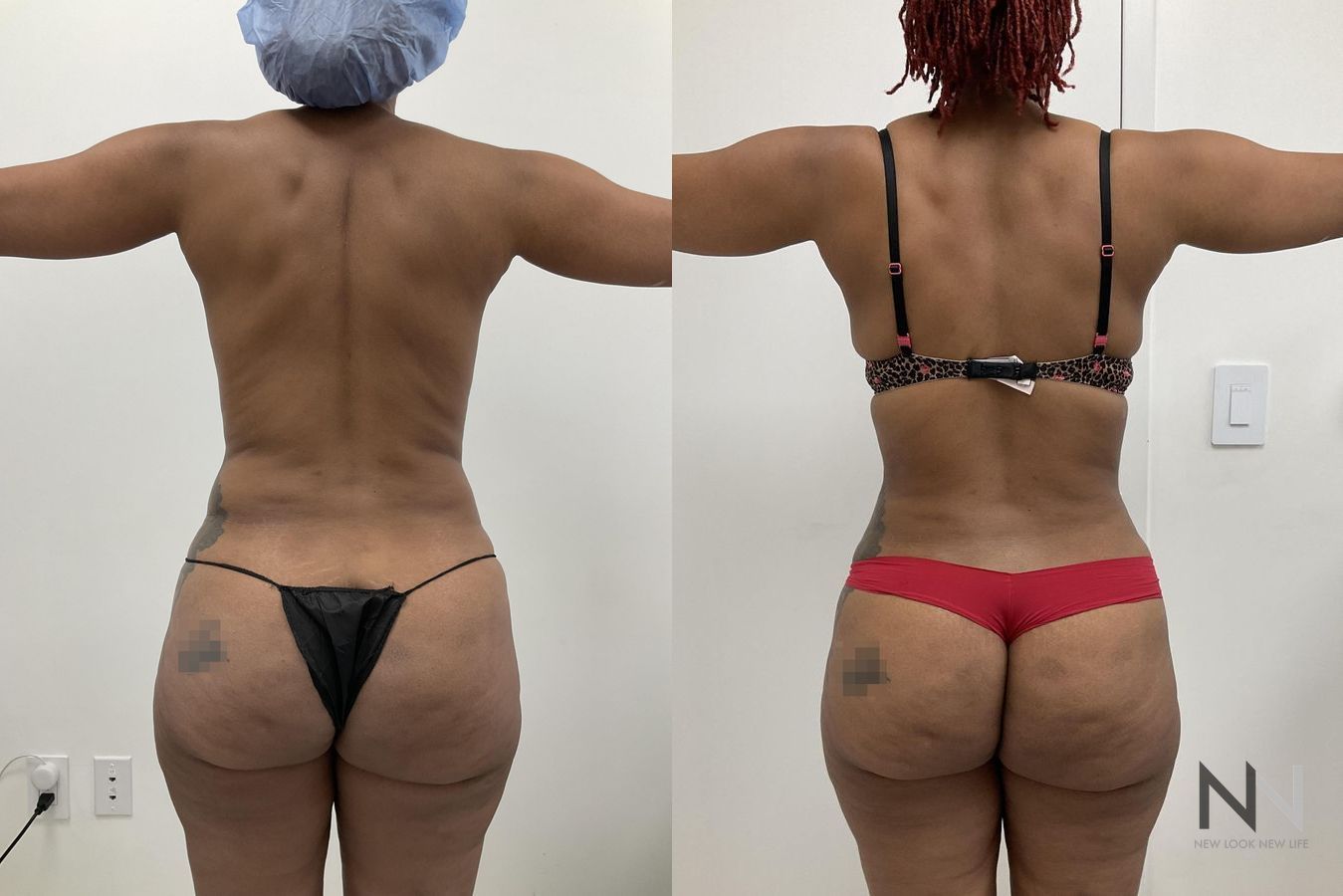 Before and after VASER liposuction with J-Plasma six months results - Angle 5