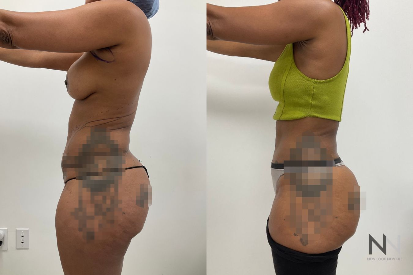 Back view before and after female liposuction highlighting significant flank reduction and an accentuated hourglass shape by Dr. Claudia Kim in NYC. - Angle 3