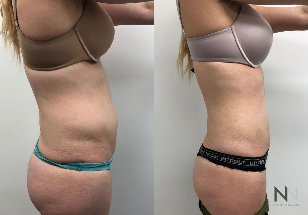 Liposuction - Thumbnail 2