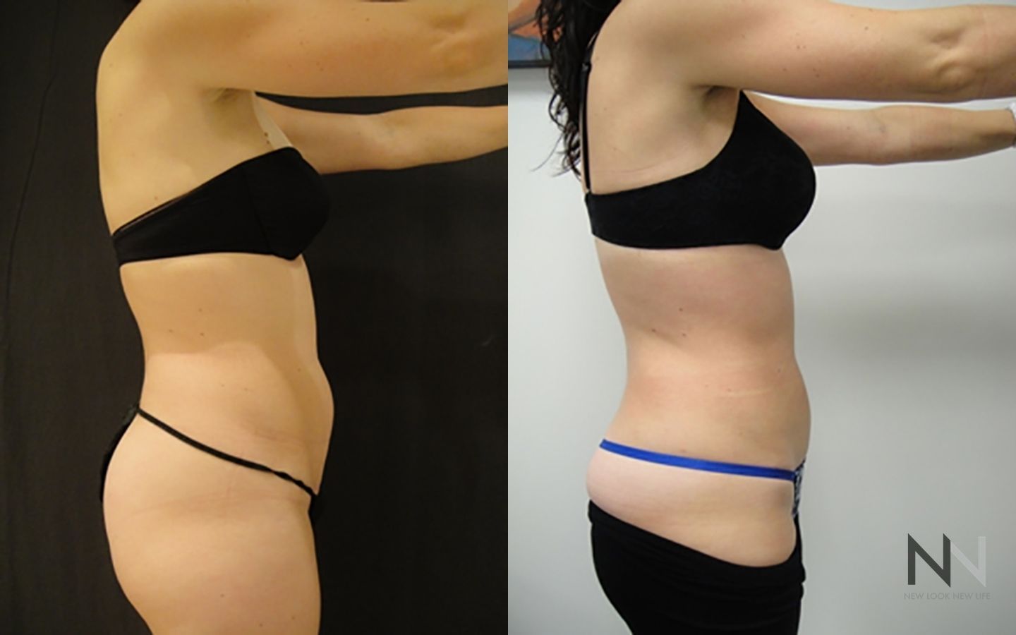 Before and after liposuction six months results - Angle 3