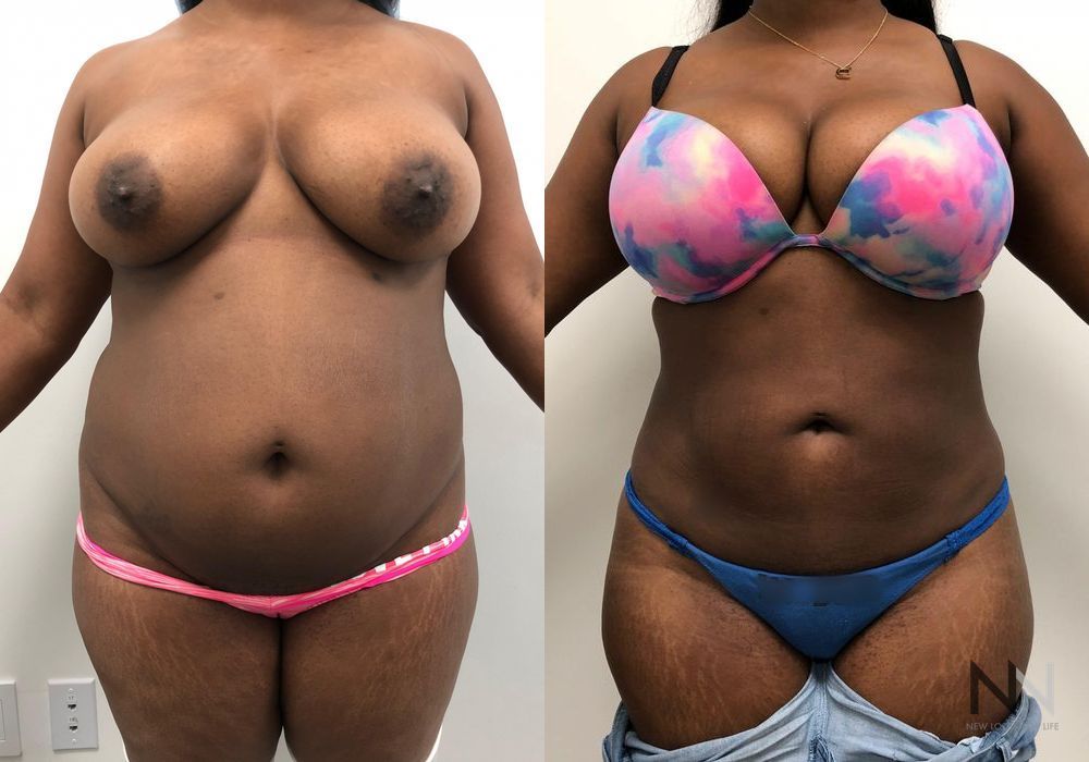 Liposuction - Case 2068