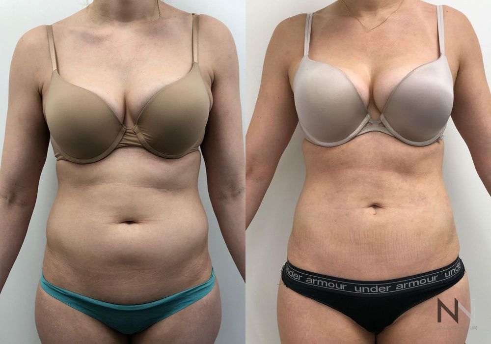 Liposuction - Case 2066