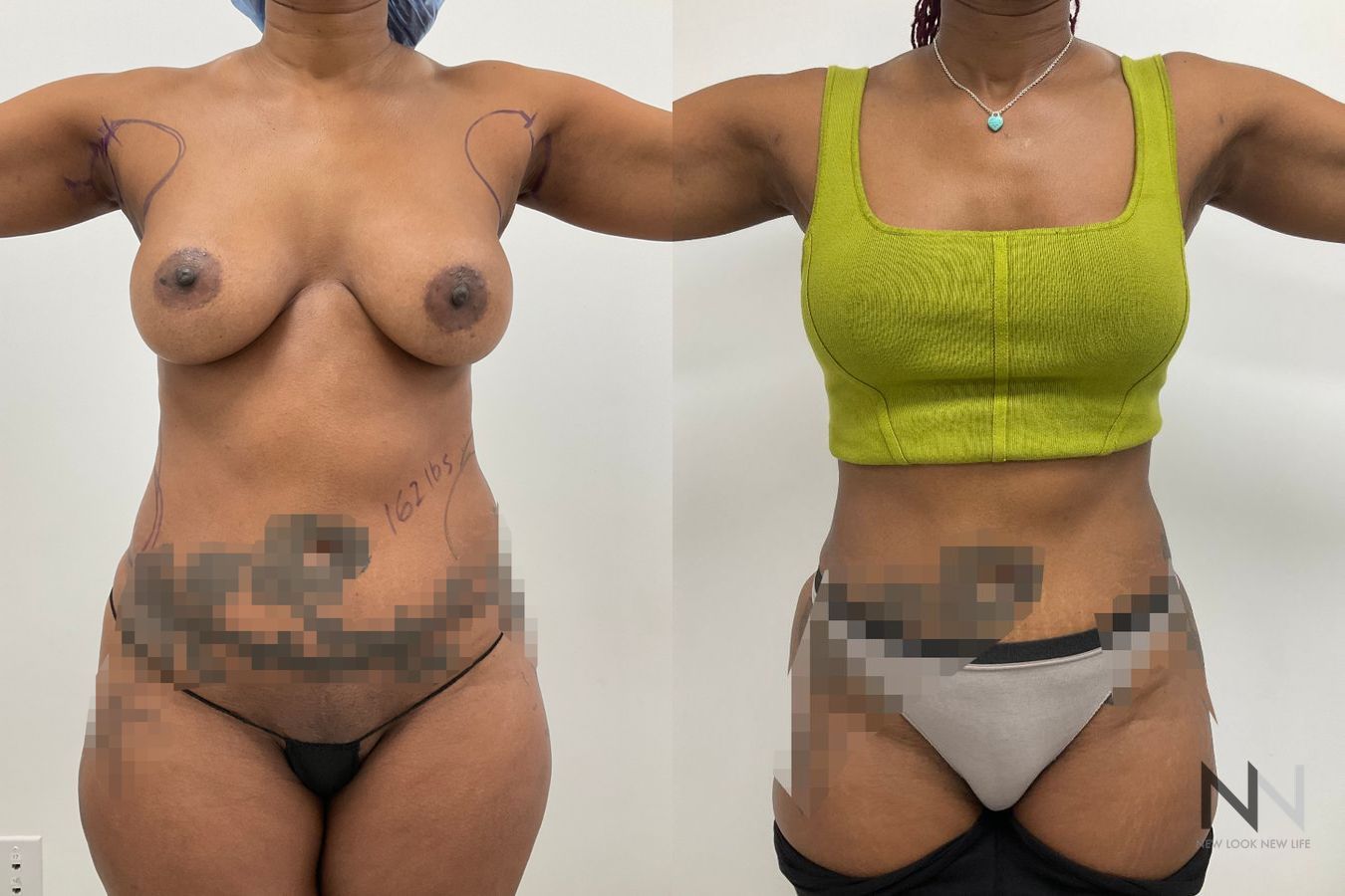 Back view before and after female liposuction highlighting significant flank reduction and an accentuated hourglass shape by Dr. Claudia Kim in NYC. - Angle 2