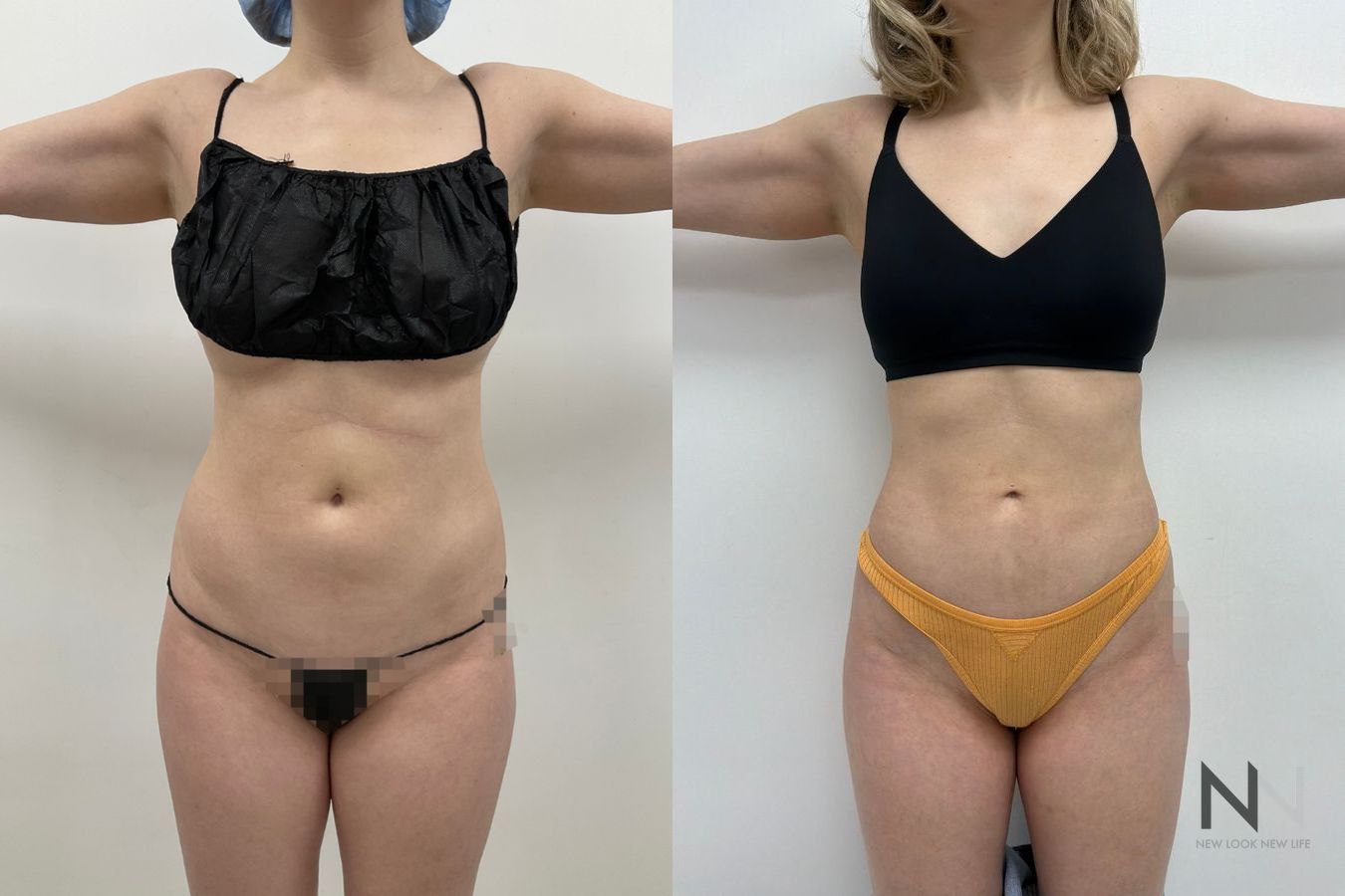 Liposuction 360 before and after showing abdominal, flank, back, and waist contouring by Dr. Claudia Kim in Manhattan, NYC