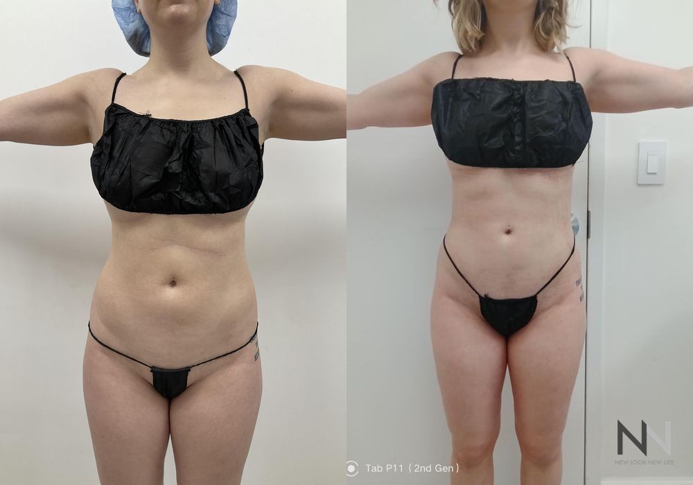 Liposuction - Case 1887